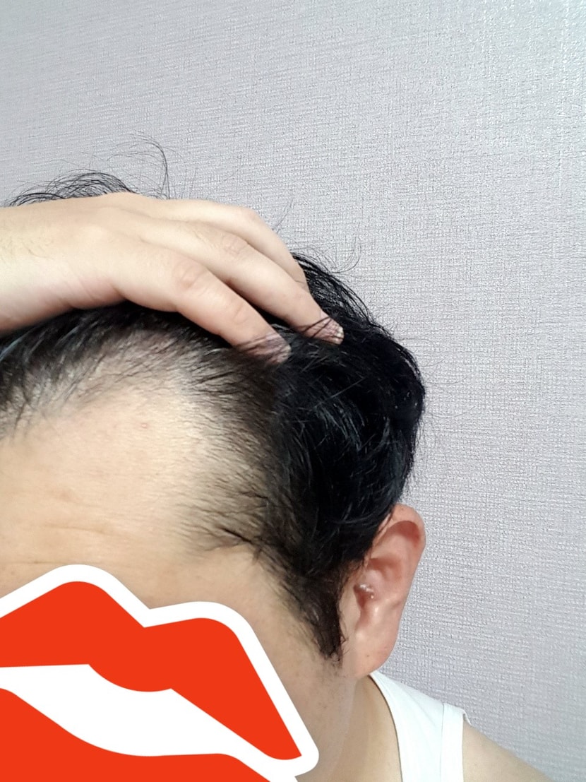 수술전