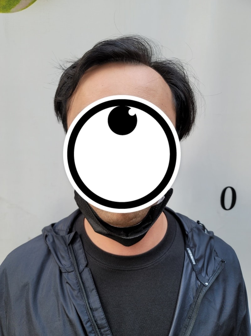 절개로 3636모 모발이식 후기 작성합니다