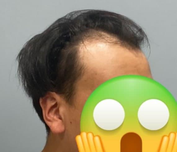 毛发移植切开+非切开毛囊2700毛数5500大量移植,进行人生逆转手术第6个月后期。