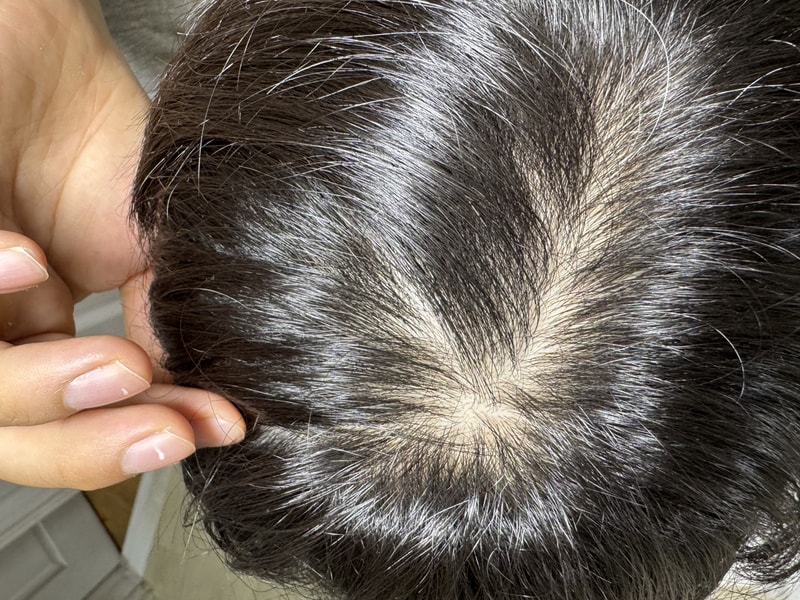 27살 탈모인지 봐주세요