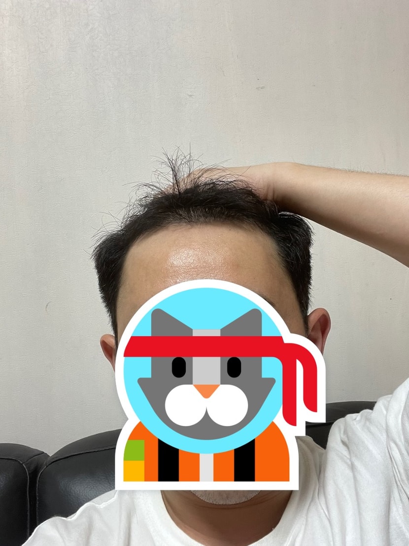 수술전