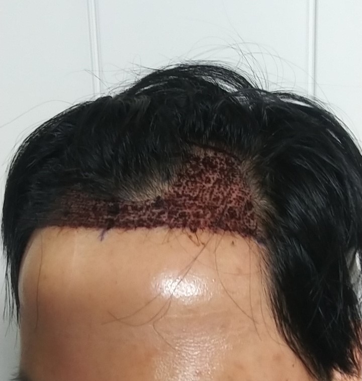 수술 하루차라 피딱지가 보입니다