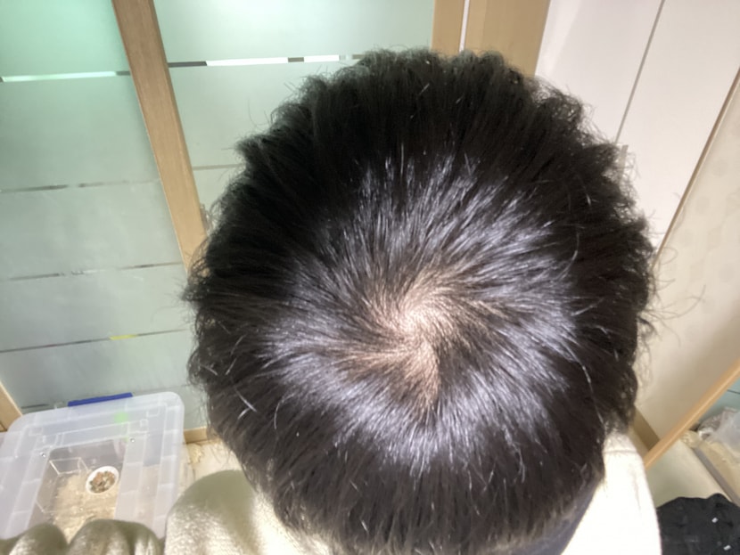 2번 째 사진 이후로 아보다트를 제외한 모든 약 중단 후 약 2년 뒤