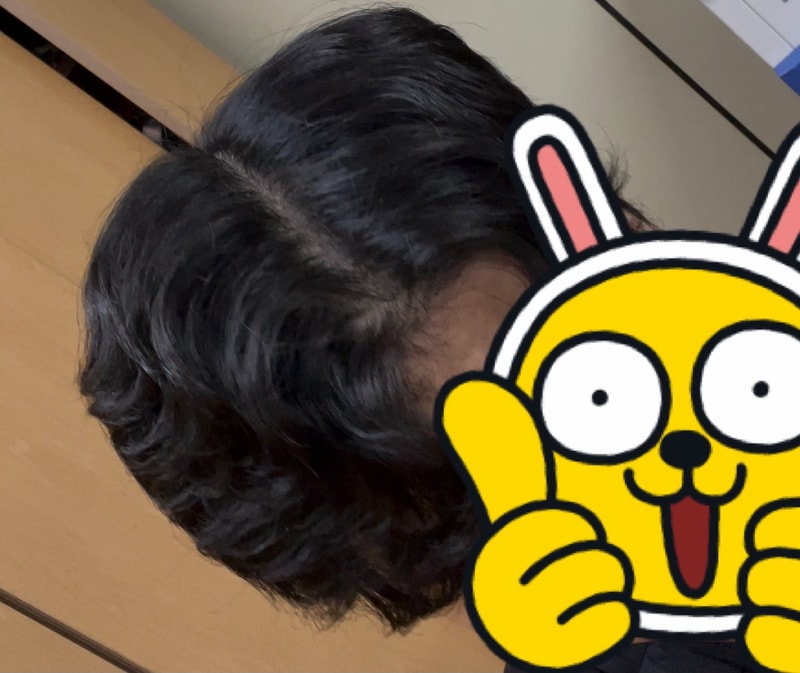 탈모가 무서운 속도로 진행돼고 있습니다..