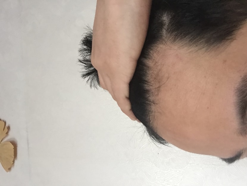 탈모초기