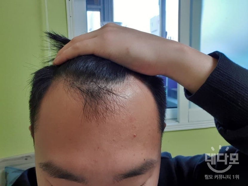 수술전
