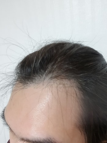수술전