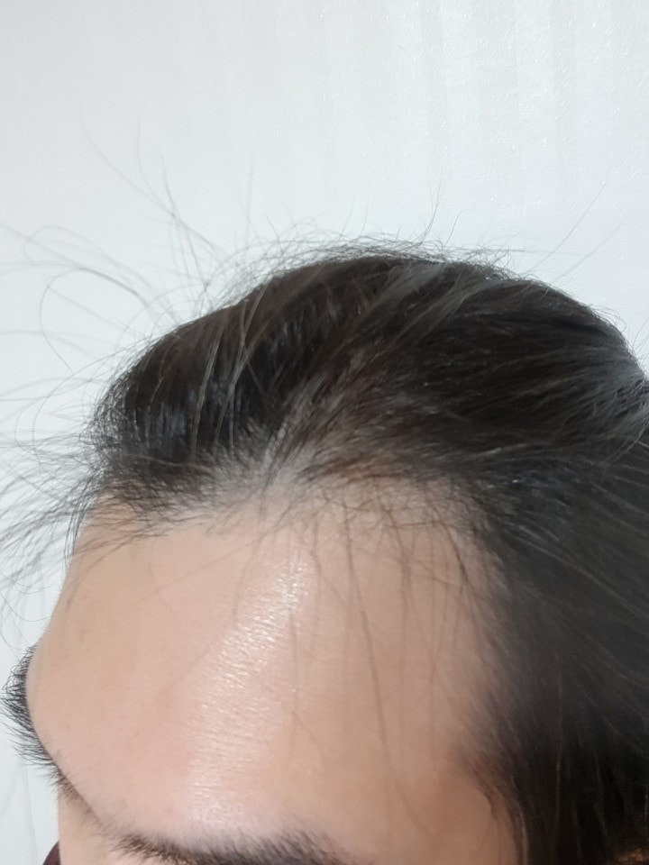 수술전