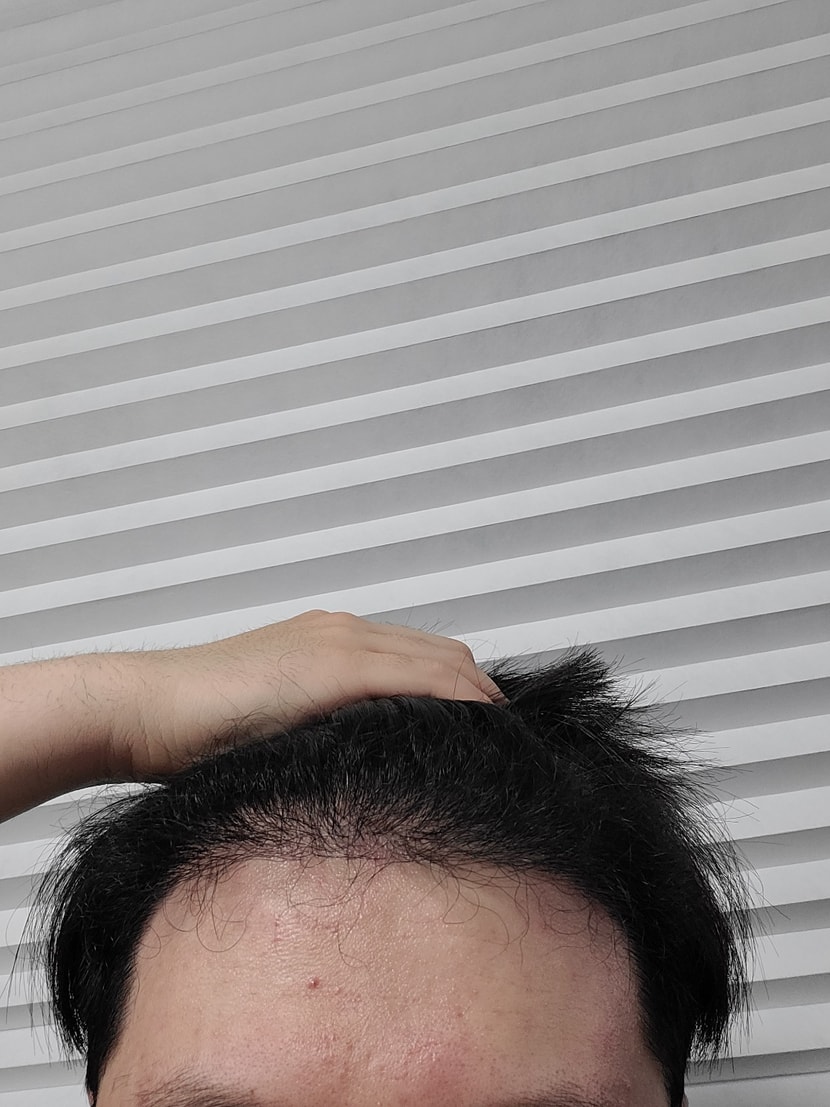 수술후