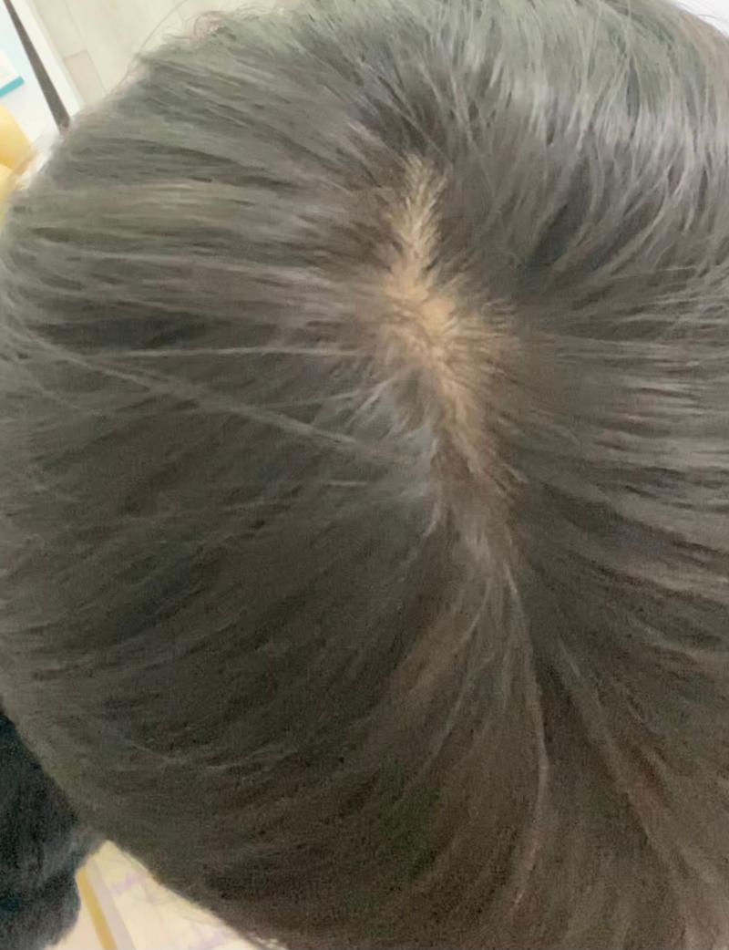 是脱发吗..