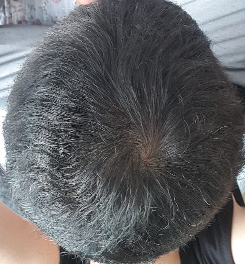 지금의 정수리(열심히 빗은 상태)