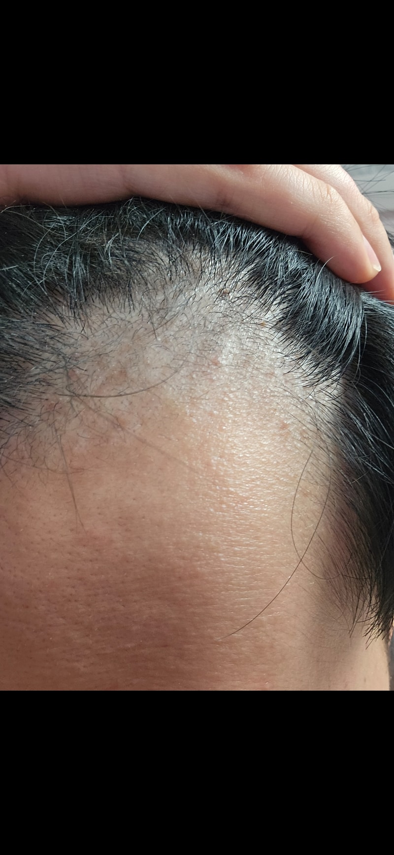 탈모약 복용 2개월차입니다.