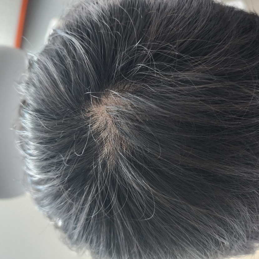 정수리 사진(현재)