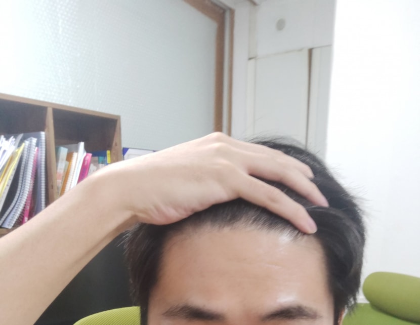 현재 이마라인 사진입니다.