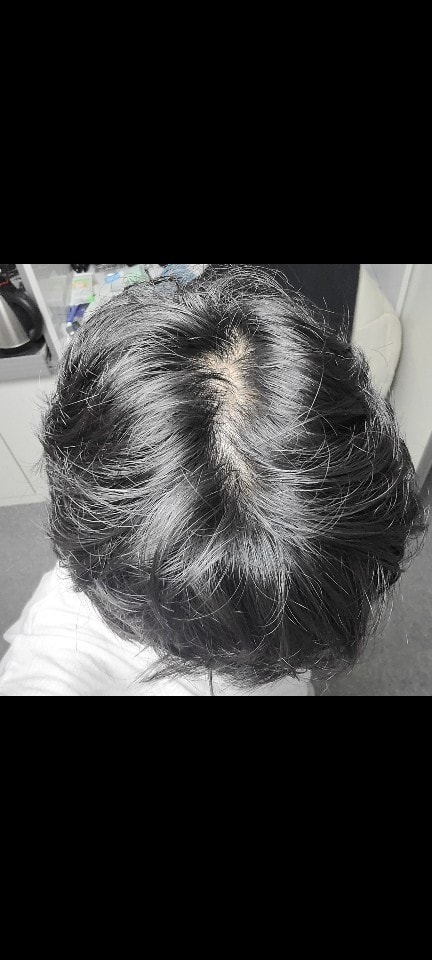 치료 중간기 (3개월차) 가르마 개선은 모르겠으나 두피자체가 조금 밝아짐
