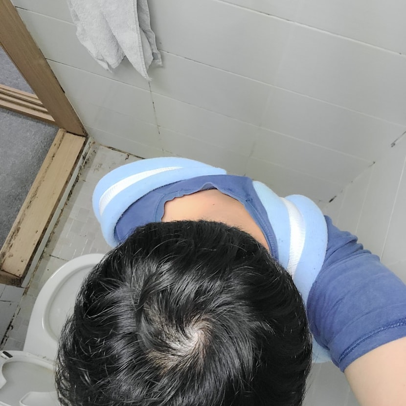 현재 - 무리해서 가르마를 벌리지 않는 한 자연스레 채워진 느낌을 받고 정수리도 재 모양을 찾은듯