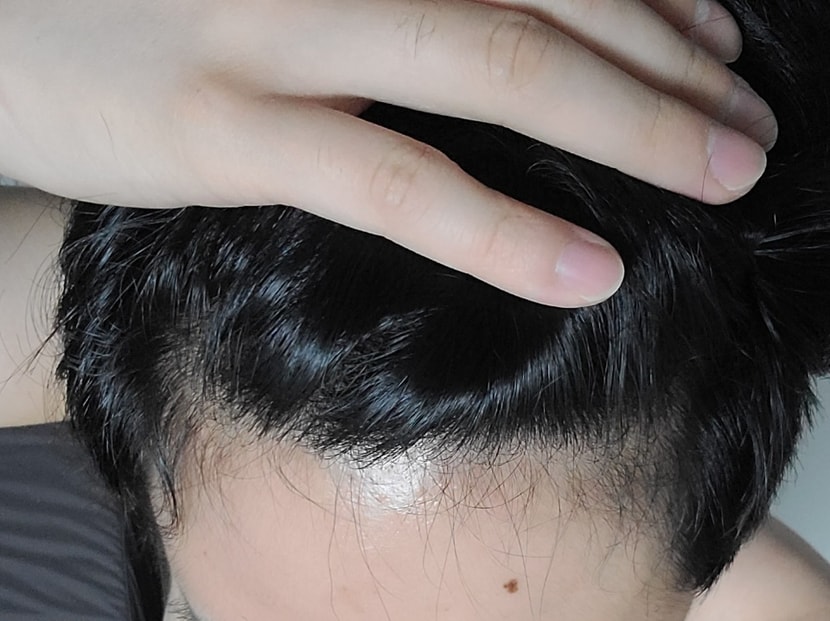 현재 M자 부분, 처음과 비교했을 때 잔털이라기엔 조금 두꺼운 모발이 새초롬하게 내려가있음