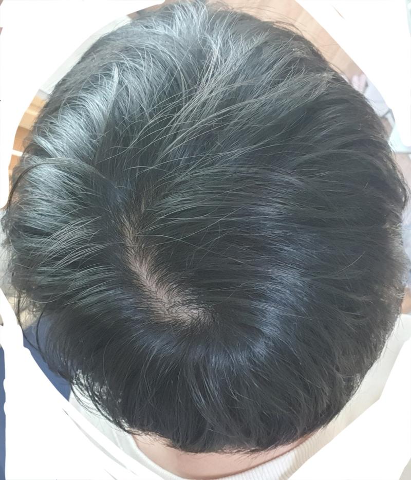 프로페시아 4개월차 기록용