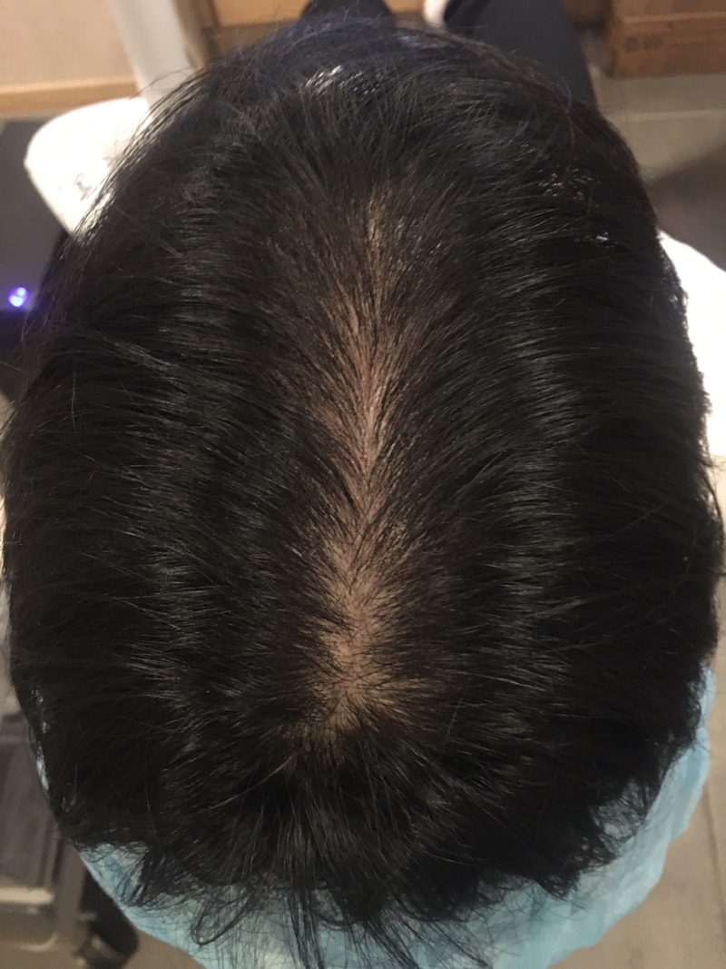 뉴헤어 최신탈모치료 1회차 후기