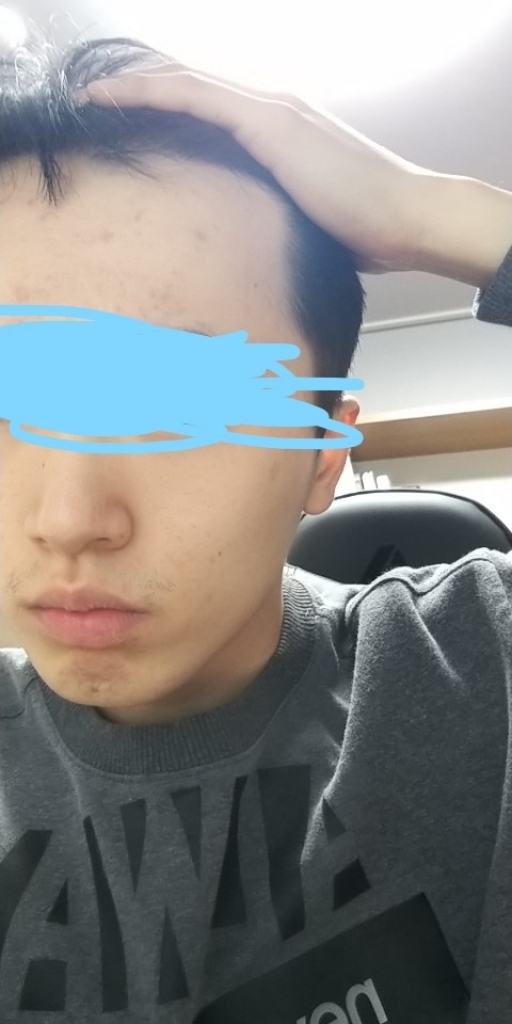 수술후 셀카