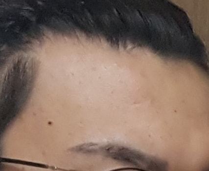 22살 m자 탈모 심한가요..? 앞으로 복용 여부 고민됩니다.