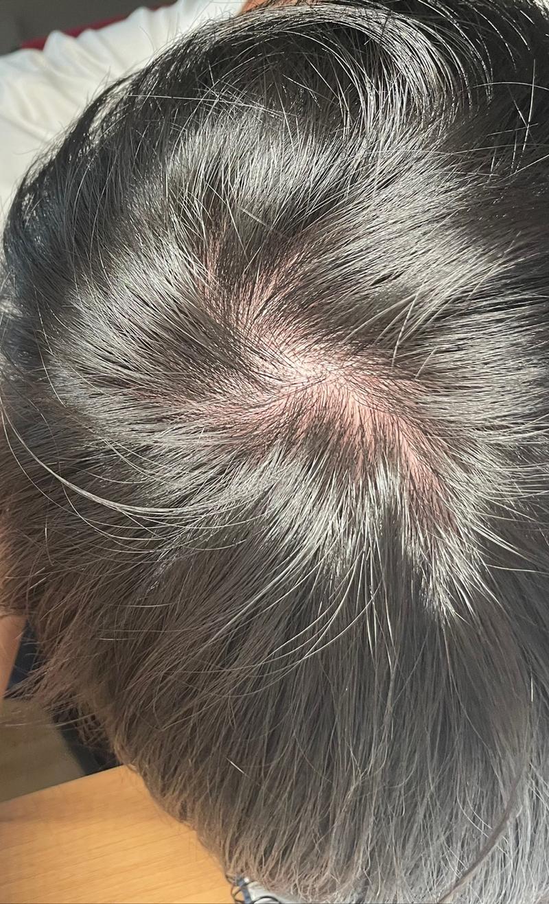 流血服用8个月.. 哈... 丝毫没有好转的迹象