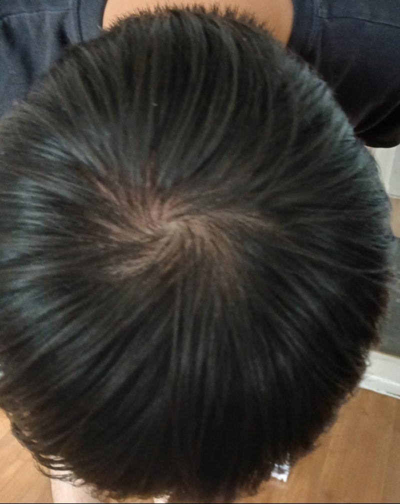 98年生まれの男です これは脱毛ですか