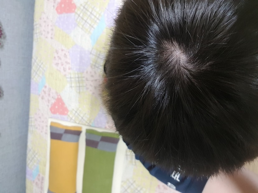 정수리2