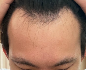 6개월 넘게 복용한 상태 전두부 부위가 빨개짐