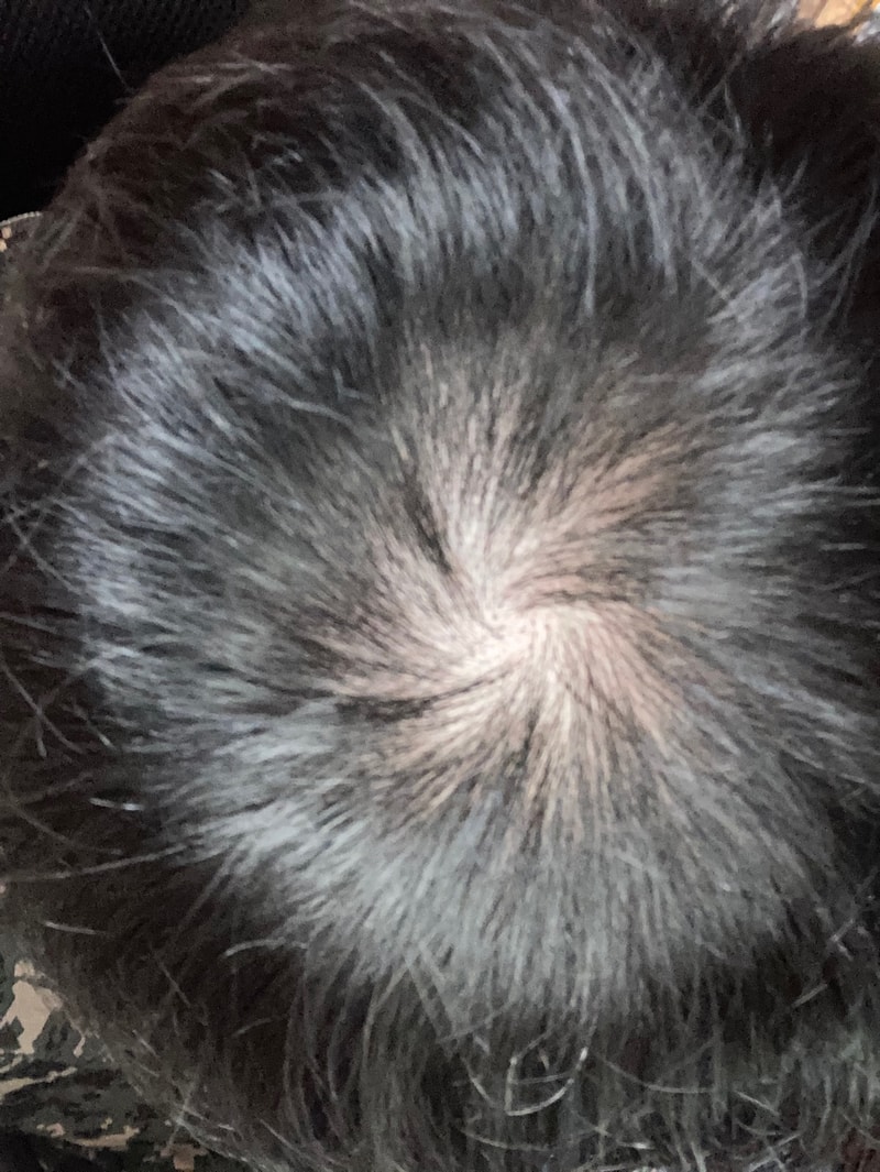 정수리 탈모 이 정도면 초기 지난거죠?..