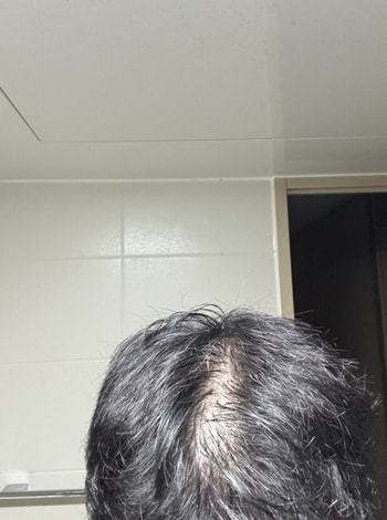 바르고난후 7월 심각합니다