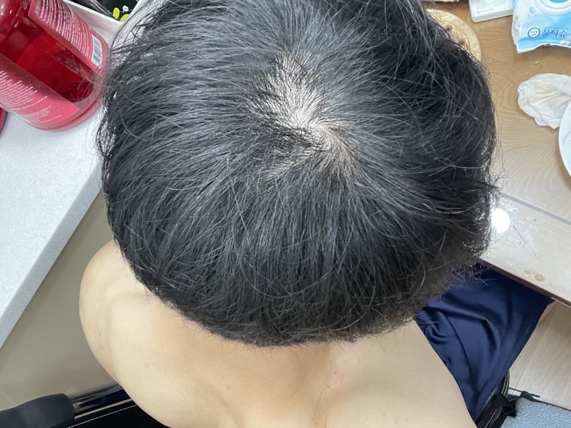 頭頂部の薄毛ですよね？？
