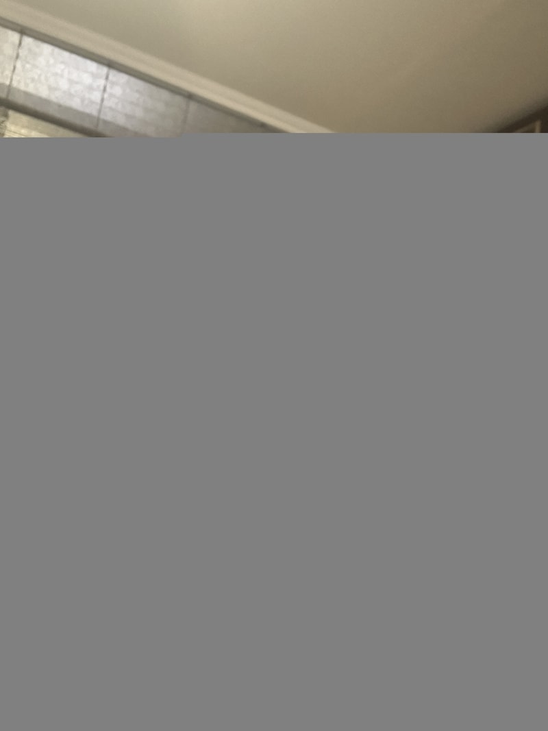 Minoxidil Infinite Shading After Hair Transplantation...