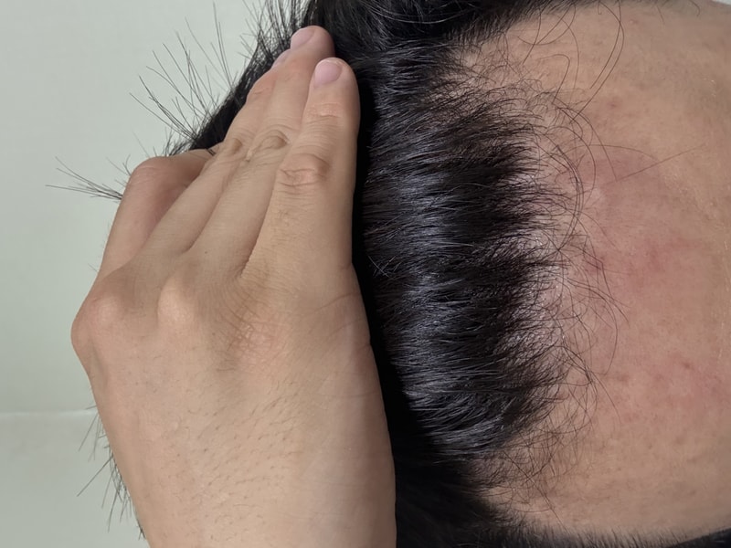 23살 탈모 어느정도 진행인가요?