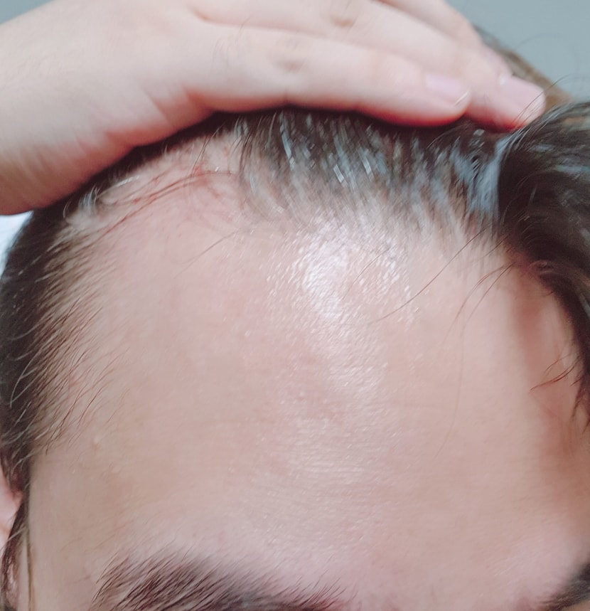 치료 초기