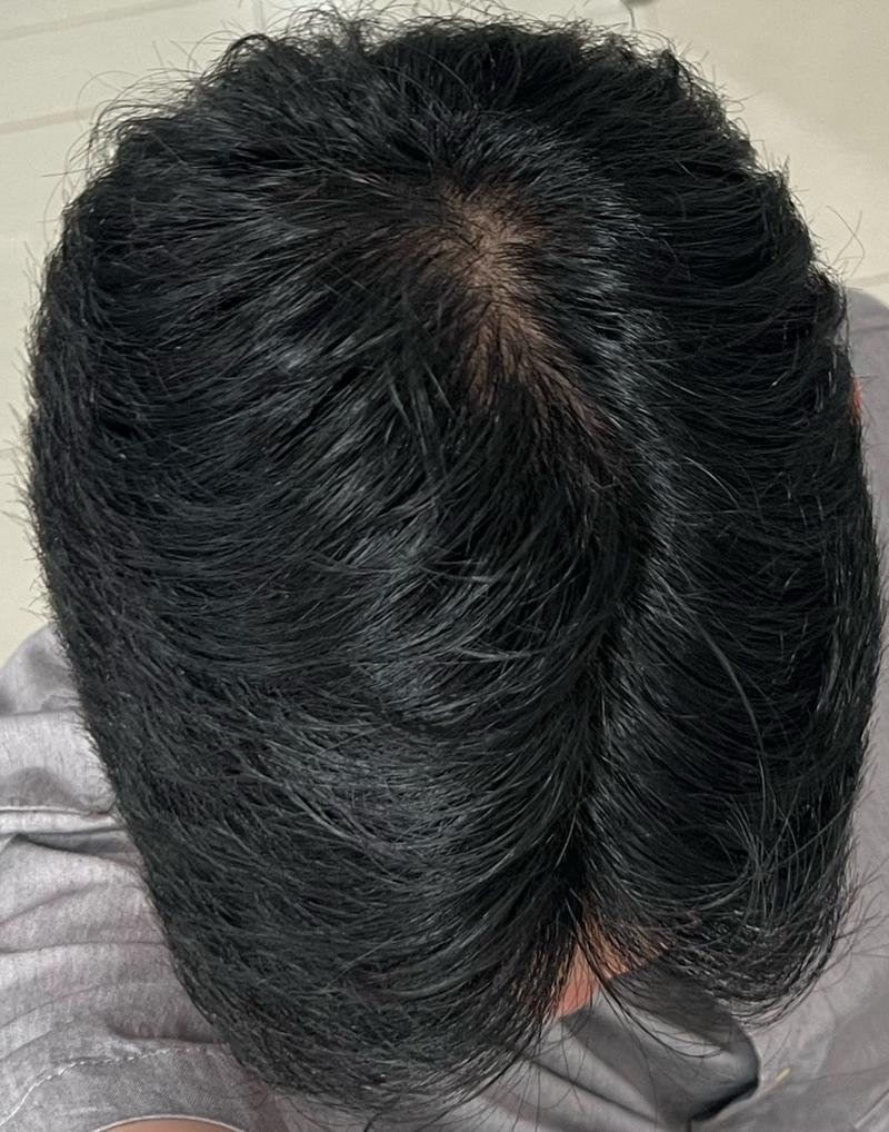 오늘 병원가서 주사치료 결제하고 왔습니다 (30살 유전/전두부 탈모)