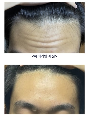 탈모 의심 1개월차