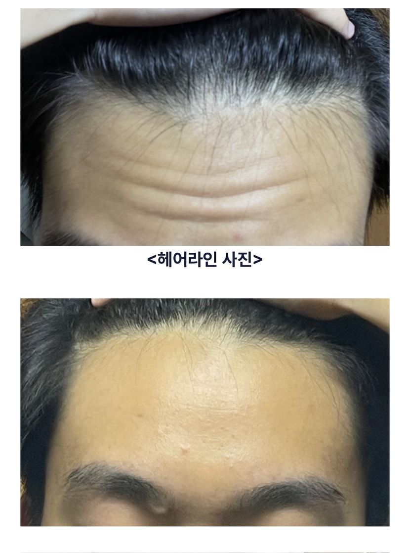 탈모 의심 1개월차