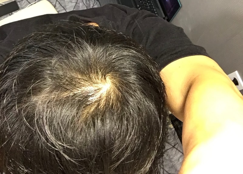 问一下脱发类型。