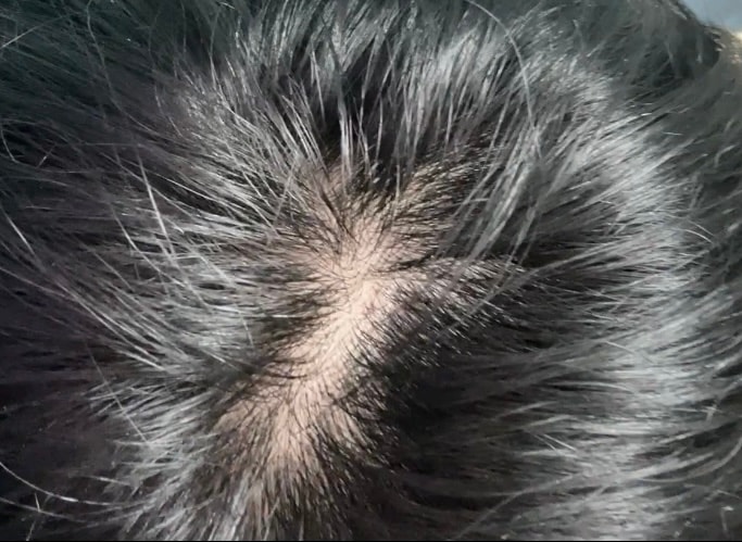 정수리 쪽에 숱이 없어 보이는데 괜찮은가요?