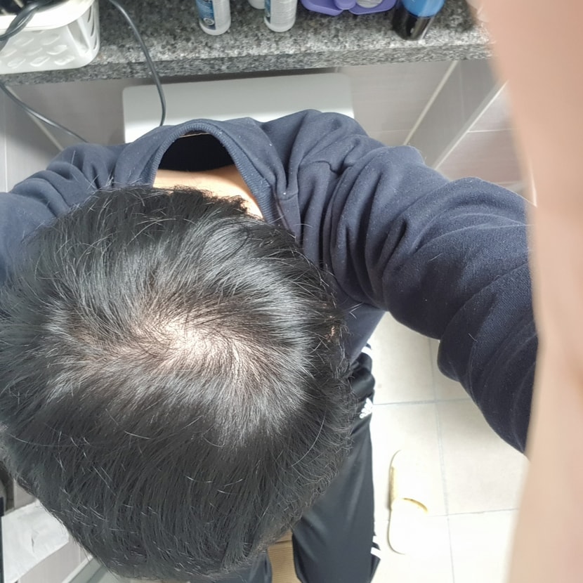 2개월 복용