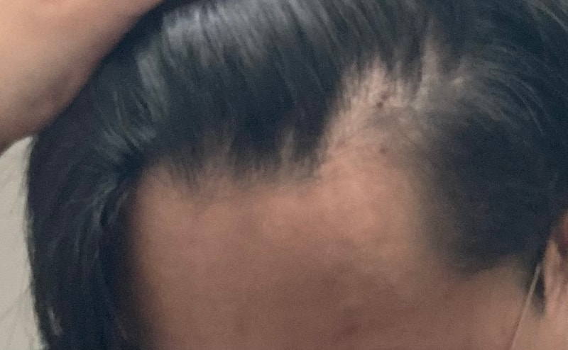 24살 정수리 탈모일까요