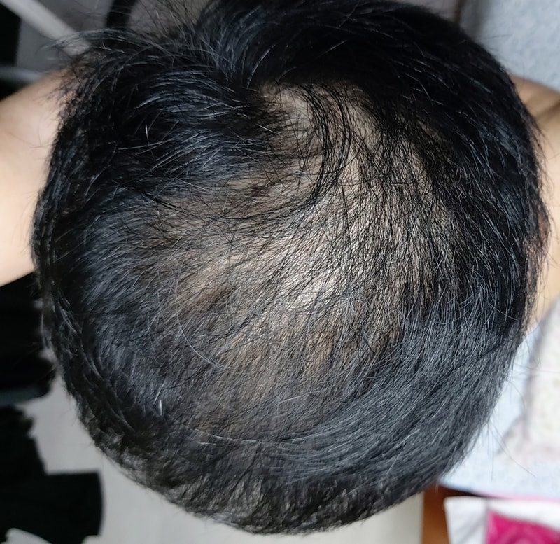 頭頂部薄毛の株注射治療を始めました