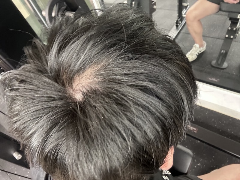 30대 후반 정수리탈모 시작