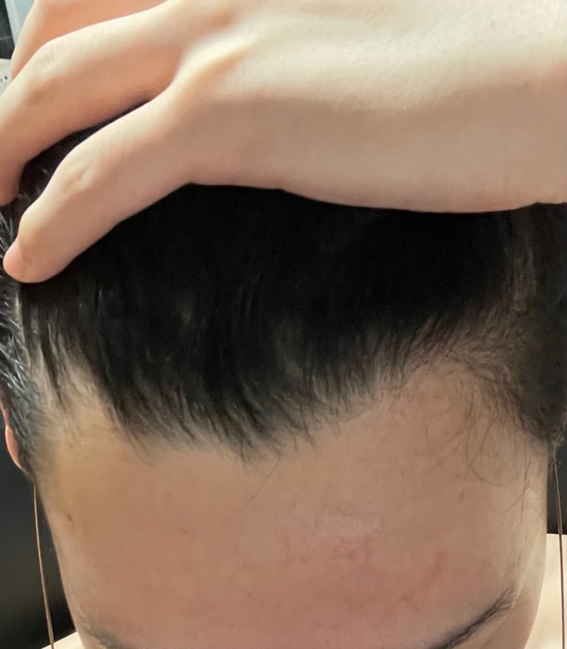 M자 탈모 고민상담