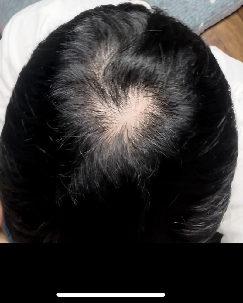 정수리 탈모 모발이식 해야할까요?