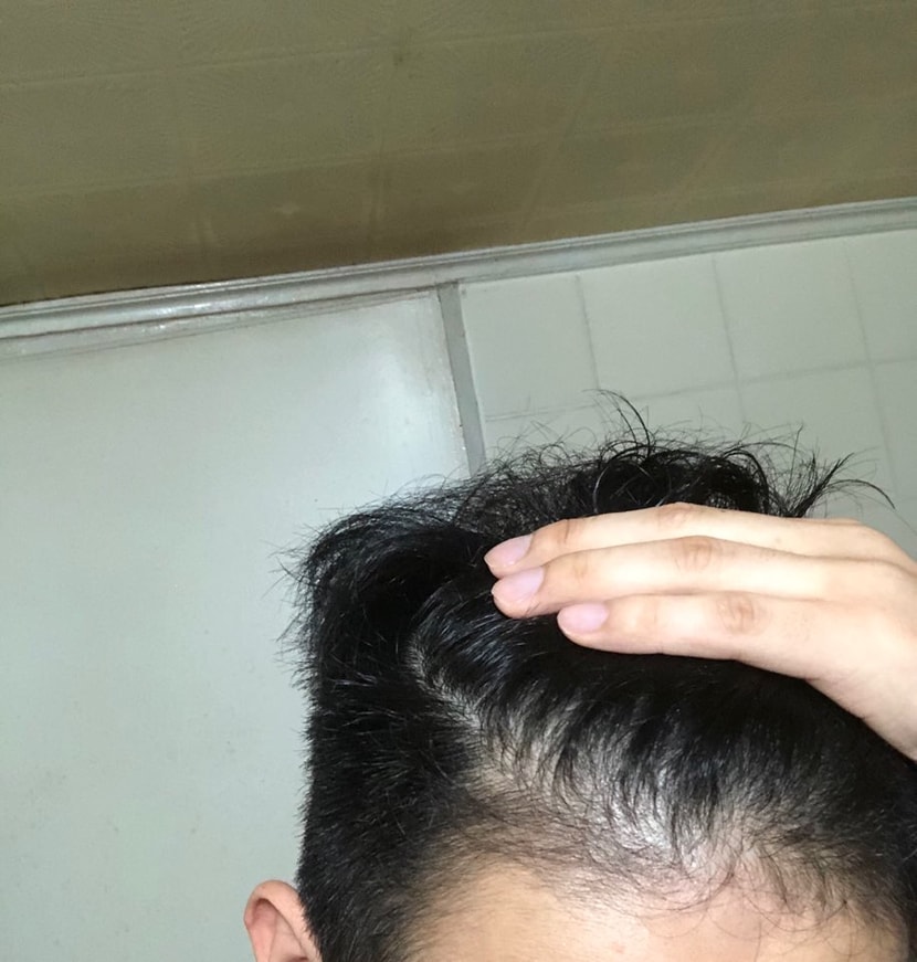 3(셋째사진). 머리감고나서바로 오른쪽, M자부분 오른쪽