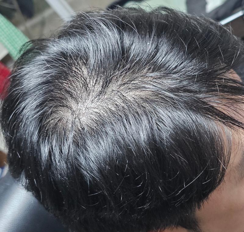 탈모 시작된 것 같습니다