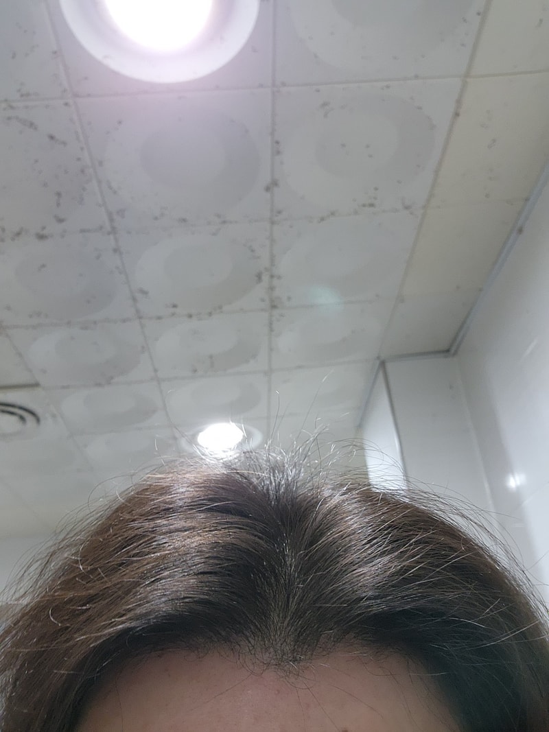 薄毛N年後の変化