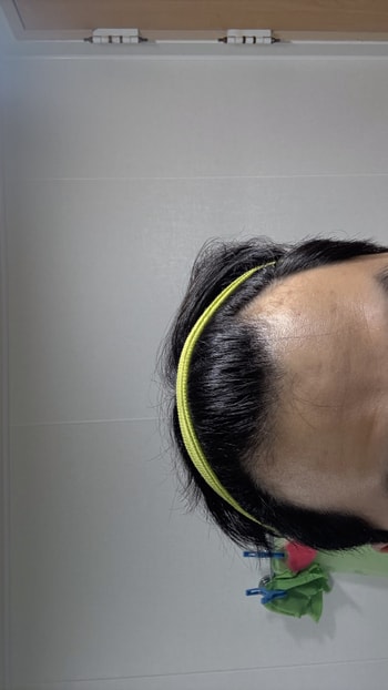 정면샷입니다. m자 깊이는 3cm 정도 되는 거 같고 중앙은 헤어라인에서 눈썹까지 5-6cm 정도 되는 거 같습니다